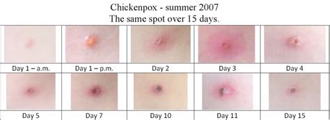 Learn how to identify hives rashes with this gallery of hives pictures. What is Chickenpox (Varicella) | Health Life Media