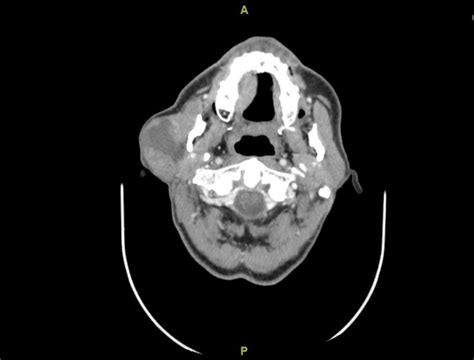 Cureus Basal Cell Adenoma Of The Parotid Gland A Rare Disease Entity