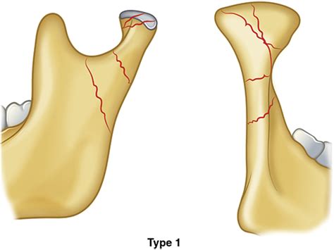 Figure 1 From Classification Of Mandibular Condylar Fractures