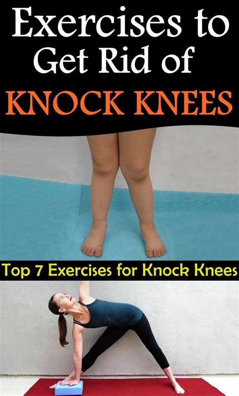 Exercises To Get Rid Of Knock Knees In 2020 Knock Knees Exercises