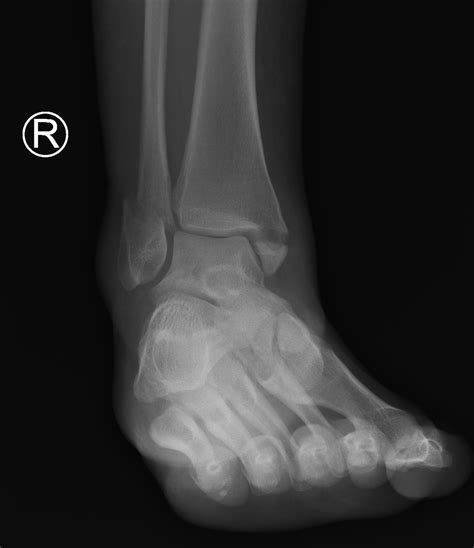 Normal Ankle Xray Tikloimagine