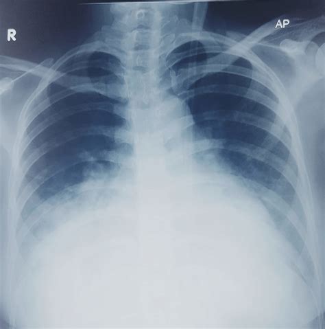 Chest X Ray On Admission Showing Cardiomegaly Bilateral Pleural