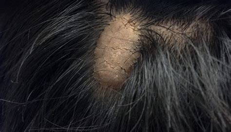 Derm Dx A Warty Patch On The Scalp Clinical Advisor