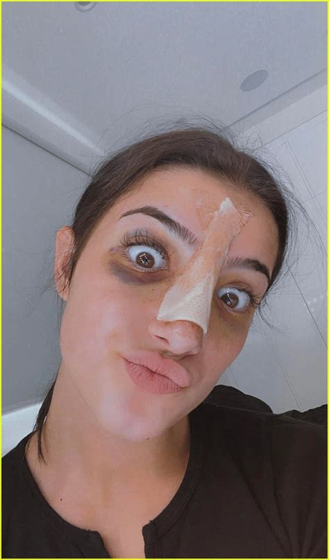Charli Damelio Shares New Selfies Post Nose Surgery Photo 1296087