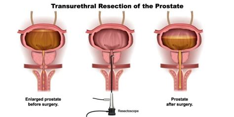 Turp Surgery Procedure Benefits Recovery And Complications Pristyn Care
