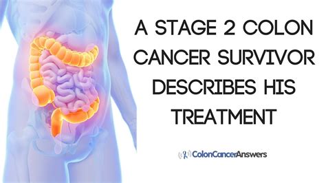 stage 2 colon cancer survivor describes his treatment youtube