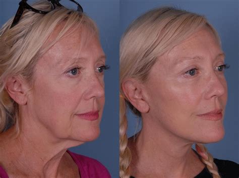 Is A Mini Facelift The Right Procedure For Me Get Fit Owasso