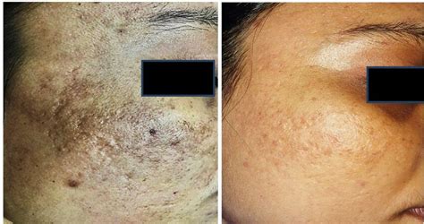 A Patient 2 Having Grade 3 Acne Scars Before Treatment And B