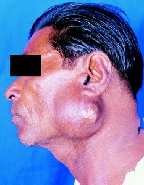 Photograph Showing Left Parotid Gland Abscess With Pus Pointing At The