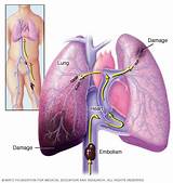 Photos of Medical Treatment For Pulmonary Embolism