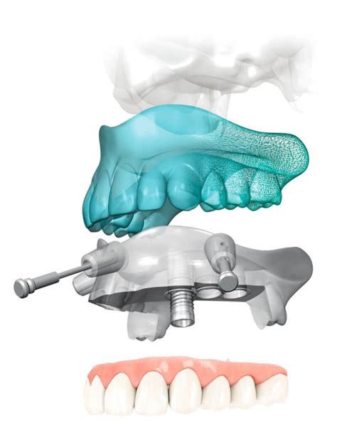 La Cirug A Guiada La Mejor Opci N En Los Implantes Dentales