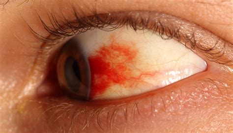 Blood Clot In Eye Due To Diabetes Diabeteswalls