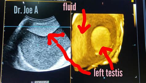 Ultrasound Imaging Left Hydrocele 3d Ultrasound