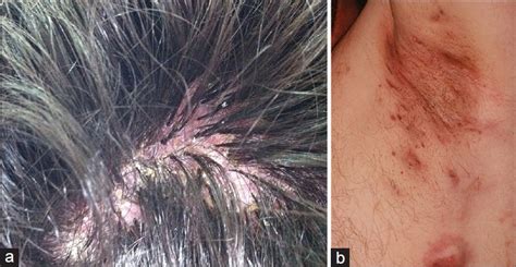 Tufted Hair Folliculitis Associated With Melkersson Rosenthal Syndrome
