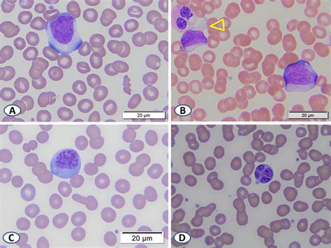 Representative Images Of Typical Reactive Lymphocytes In The Peripheral
