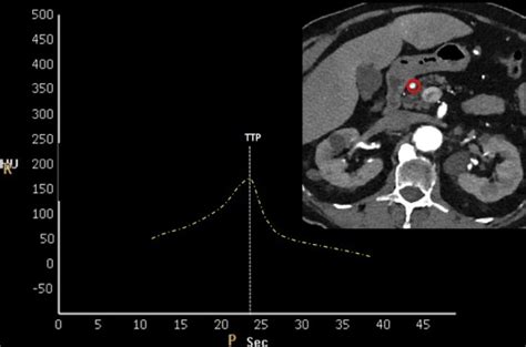 Reduced Contrast Volume And Radiation Dose During Computed Tomography