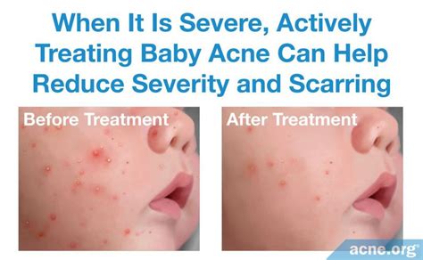 Baby Acne What Is It And What Causes It