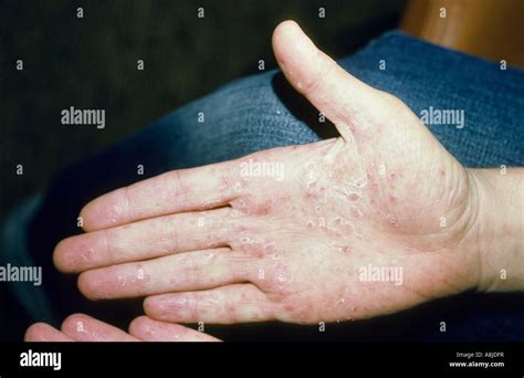 Pustulosis Palmaris Psoriasis On Palm Of A Patient Stock Photo Alamy