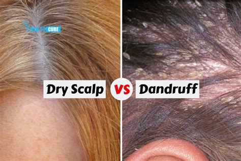 (it's different from psoriasis, which also can look like flakes — but those will appear like. Dandruff Vs Dry Scalp - The Difference And Treatment | How ...