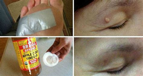 Remove Warts Blackheads Skin Tags And Dark Spots Quickly And Easily