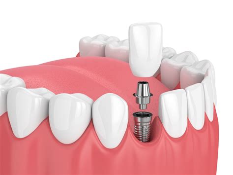 How Do Dental Implants Work Ddi Dorset