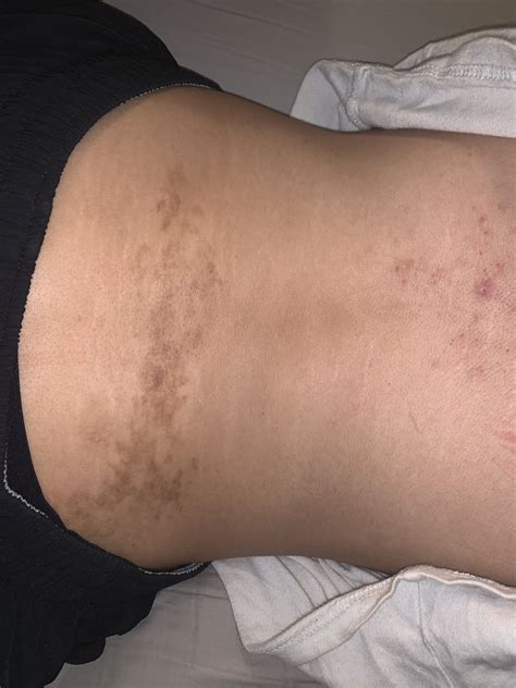 What Is This Dark Patch Of Skin On My Lower Back Askdocs