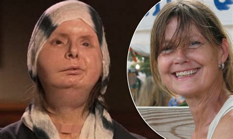charla nash s new face chimp attack victim shows off results 6 months after transplant daily