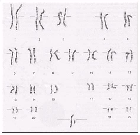 Which Chromosomes Are Shown On A Karyotype Autosomal Or Sex Telegraph