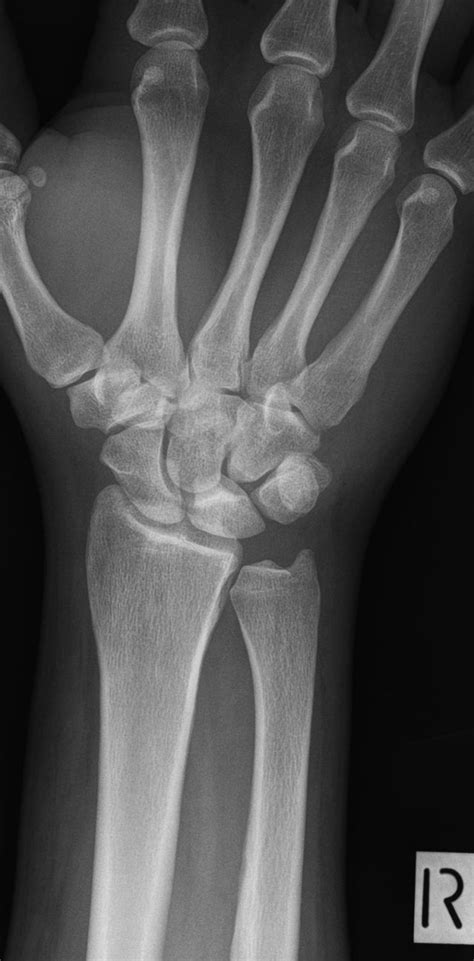 Lunate Fractures Wikiradiography