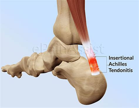 Insertional Achilles Tendonitiscausessymptomstreatmentrecovery Time