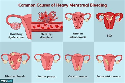 Heavy Menstrual Bleeding Menorrhagia Causes Symptoms Diagnosis