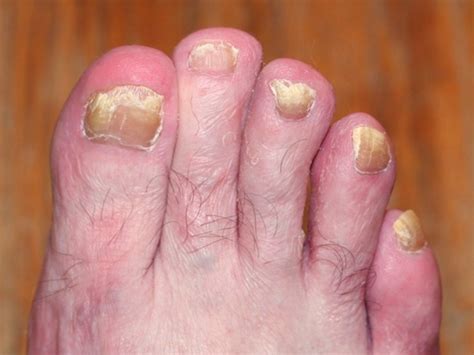 Toenail Fungus Pictures Symptoms Causes Treatment