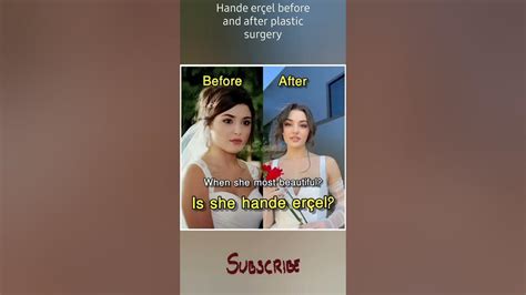 Turkish Actress Hande Ercel Before And After Plastic Surgerythen And