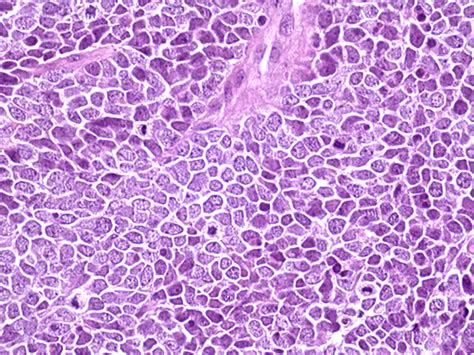 The study findings make early detection and treatment of merkel cell carcinoma a top priority. New Treatment for a Rare Skin Cancer | Center for Cancer ...
