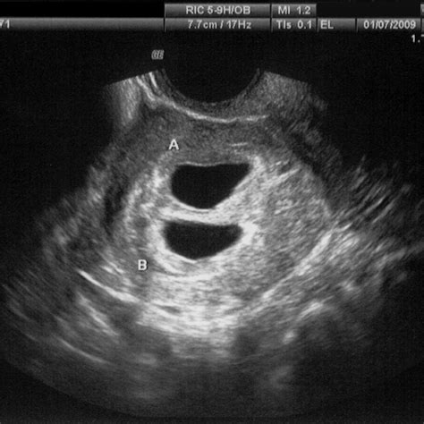Normal 20 Week Ultrasound Profile Ldwtanka