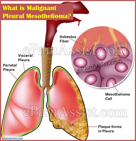 The most common metastatic symptoms of mesothelioma are: What is Malignant Pleural Mesothelioma|Causes|Signs|Symptoms