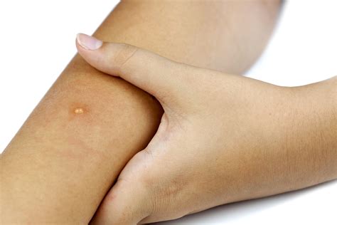 The redness may be harder to see on. Urticaria/Hives | Lynnea Villanova MD