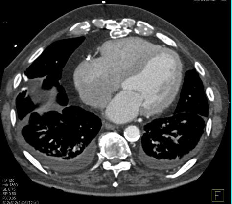 Asbestosis With Calcified Pleural Plaques Chest Case Studies Ctisus