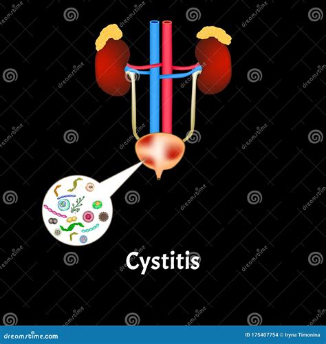 Cystitis Inflammation Of The Bladder The Structure Of The Kidneys And