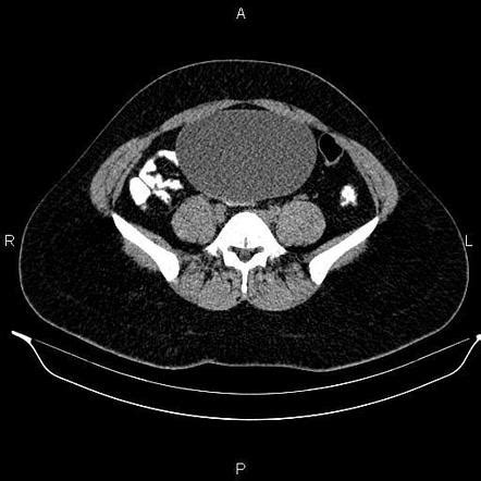 Paraovarian Cyst Radiology Case Radiopaedia Org