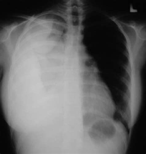 Pleural effusion (transudate or exudate) is an accumulation of fluid in the chest or on the lung. Massive hemothorax following administration of ...