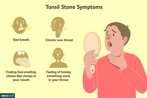 Tonsil Stones Tonsilloliths Causes Symptoms And Treatment