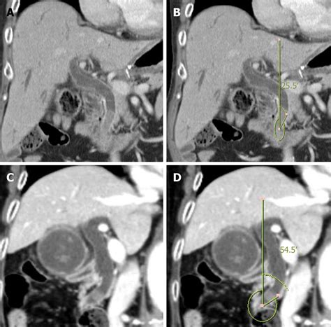 Acute Distal Common Bile Duct Angle Is Risk Factor For Post Endoscopic