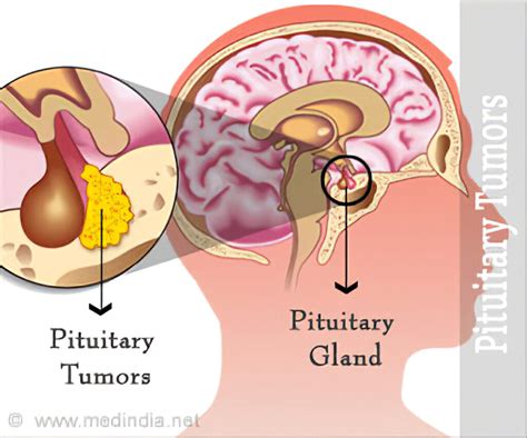 pituitary tumor1 exploring biology