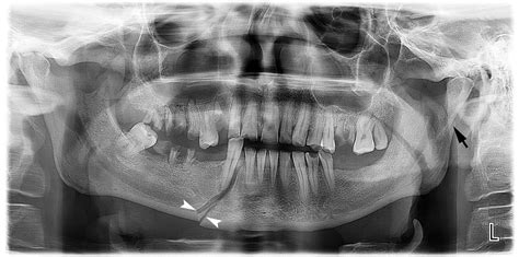 Mandibular Fractures Pre Operative Panoramic Radiography And