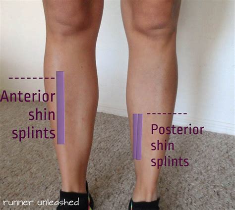 Everything A Runner Should Know About Shin Splints