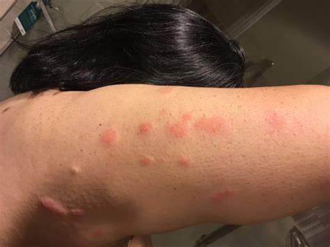 最高 50 What Look Like Bed Bug Bites サンゴメガ