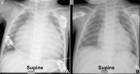Pre Operative And Post Operative Chest X Rays A Anteroposterior