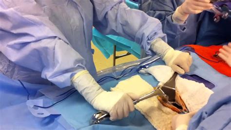 Mock Open Cholecystectomy Part Youtube