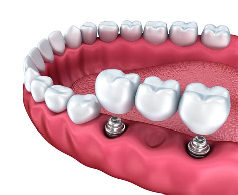 Dental Implant Procedure Essentials Bone Grafting Tooth Surgery